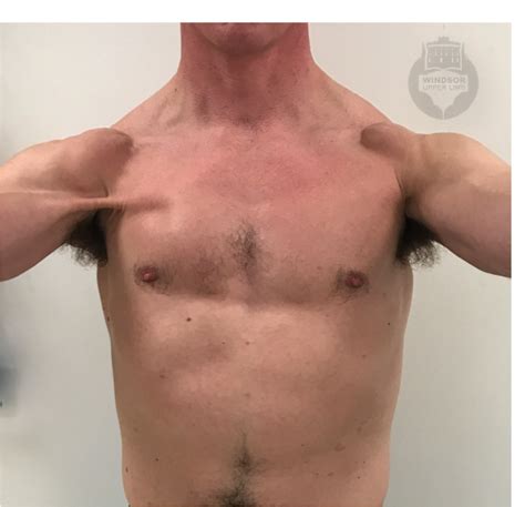 pec tear recovery without surgery